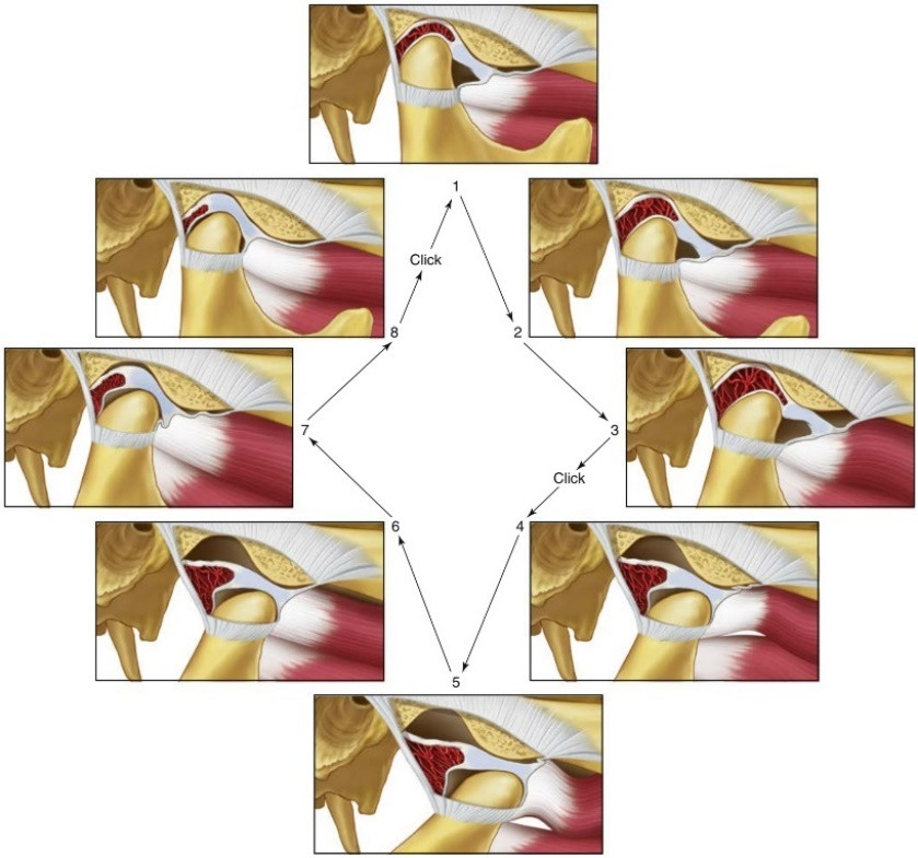 Mekanisme timbulnya bunyi (clicking) akibat pergeseran Bantalan Sendi Rahang pada kasus Disc Displacement with Reduction.