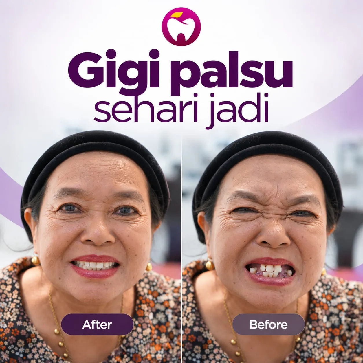 Before After Gigi Palsu Sehari Jadi