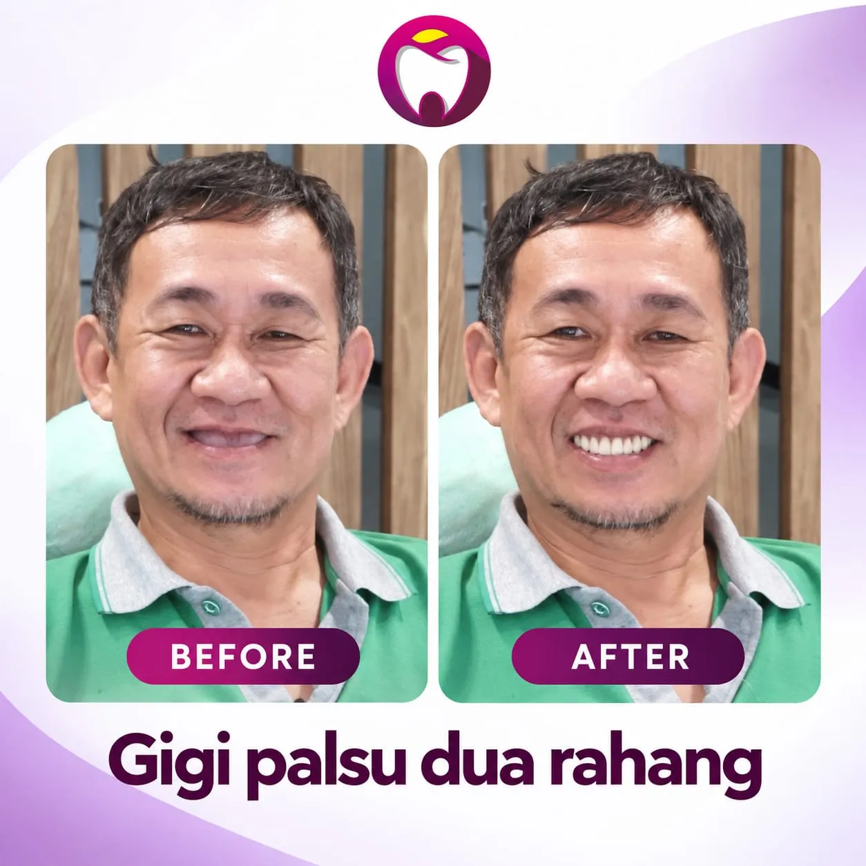 Before After Gigi Palsu Dua Rahang