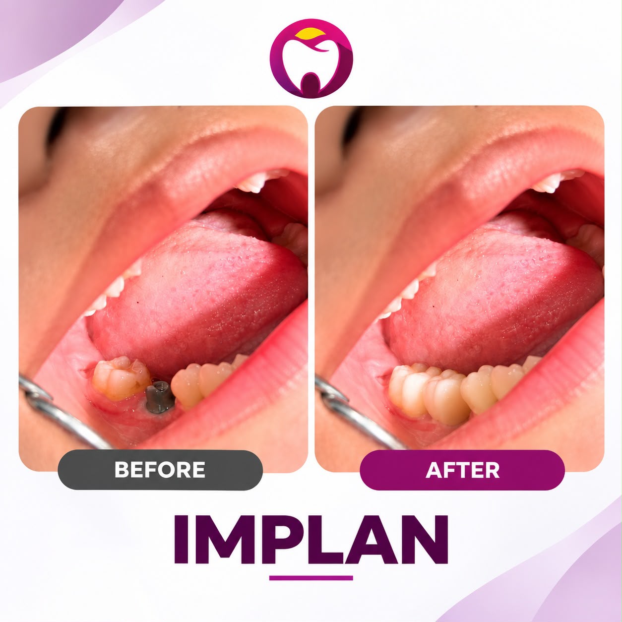 Before After Implan Gigi Sehari Jadi