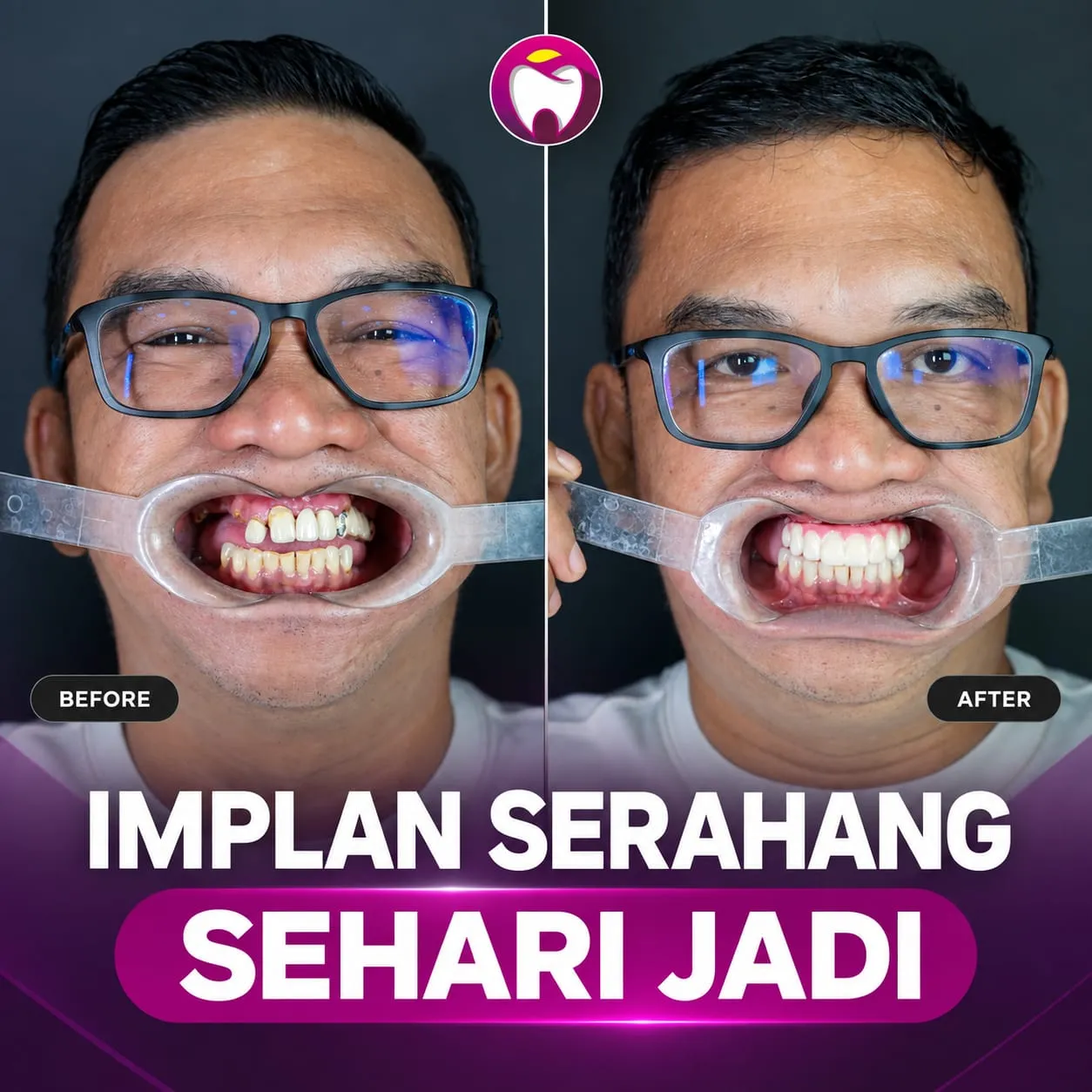 Before After Implan Gigi Sehari Jadi