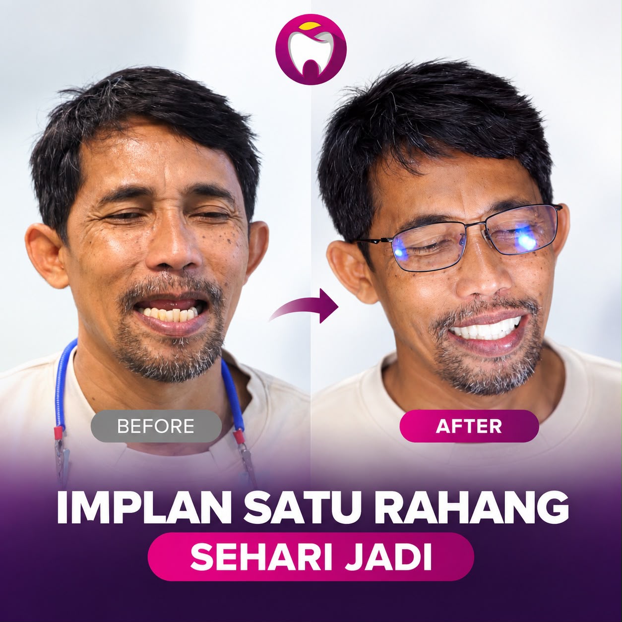 Before After Implan Gigi Sehari Jadi