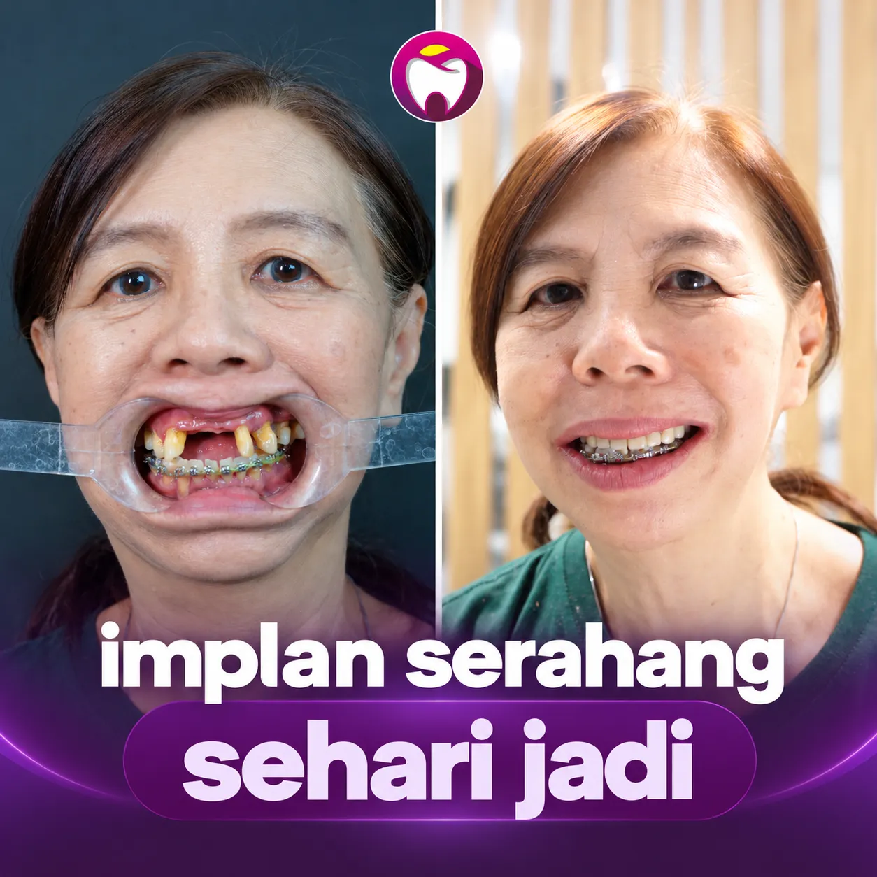 Before After Implan Gigi Sehari Jadi