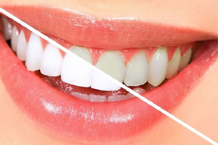 Panduan Lengkap Bleaching Gigi dengan Teknologi Laser: Keunggulan, Prosedur, dan Efek samping.