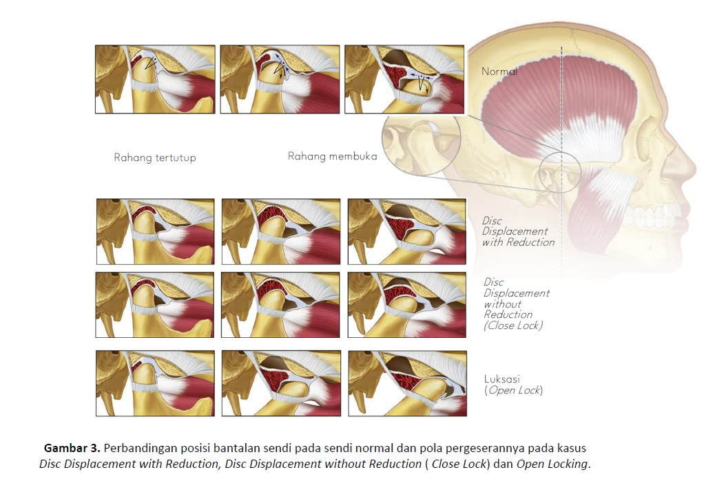 Perbandingan posisi bantalan sendi pada sendi normal dan pola pergeserannya pada kasus Disc Displacement with Reduction, Disc Displacement without Reduction ( Close Lock) dan Open Locking.