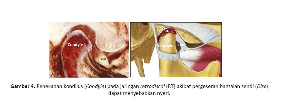 Penekanan kondilus (Condyle) pada jaringan retrodiscal (RT) akibat pergeseran bantalan sendi (Disc) dapat menyebabkan nyeri.