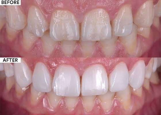Veneer Direct: Solusi Cepat dan Efektif untuk Senyum Indah