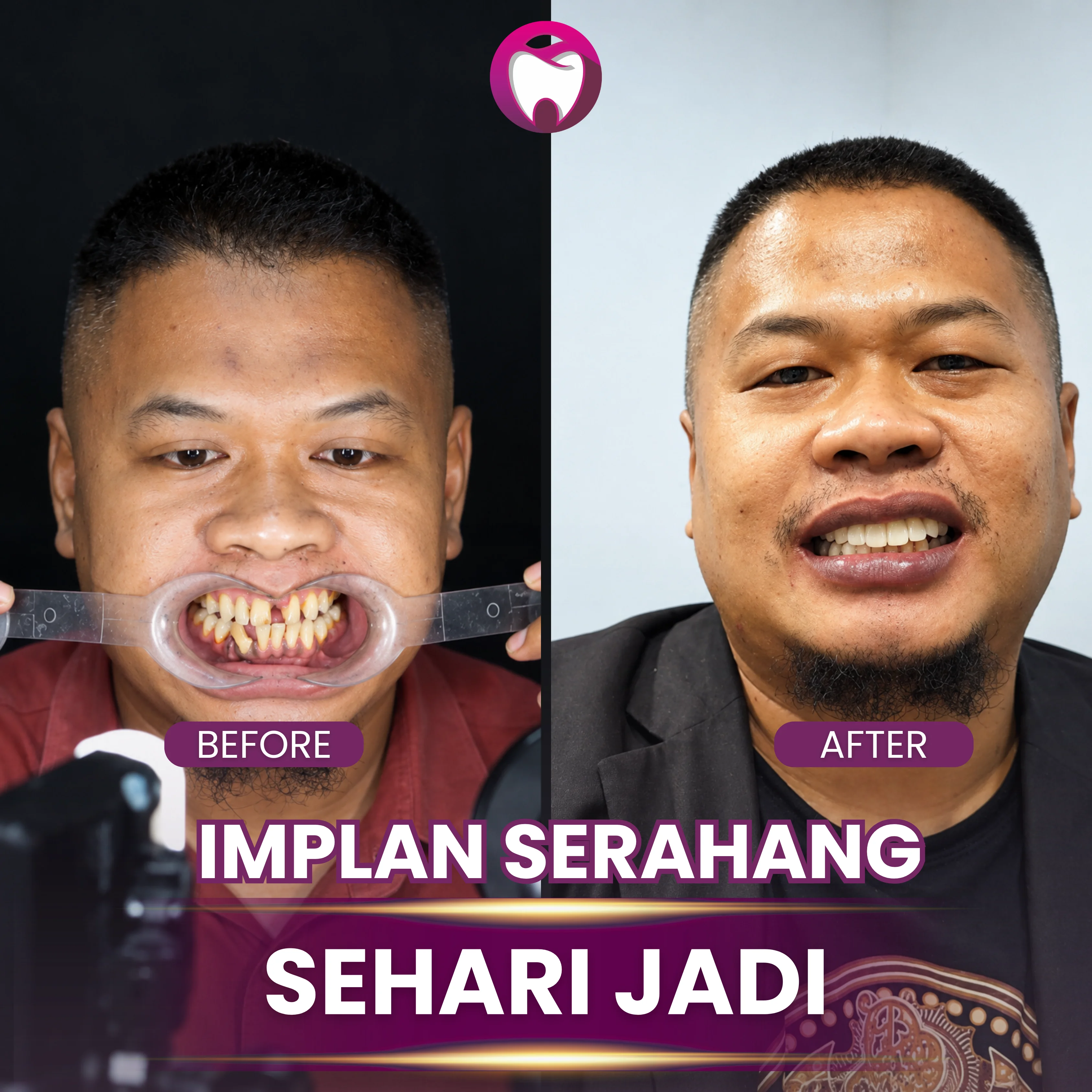 Before After Implan Gigi Sehari Jadi